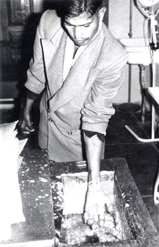 Faizabad Leprosy Home: a leprosy patient undergoing treatment for contractual fingers after reconstructive surgery performed by Dr Silas Singh of Almora Leprosy Hospital. 1970