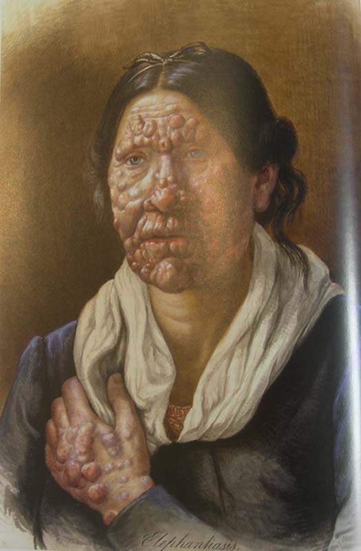 One of Losting’s beautiful portraits of a woman in Bergen’s Leprosy Asylum